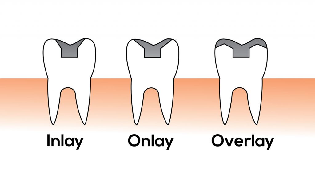 inlay onlay overlay betétek